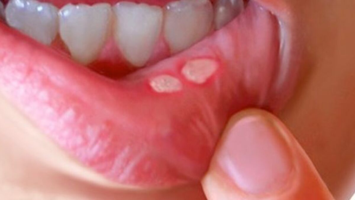 AĞZINIZDAKİ O KÜÇÜK BEYAZ KABARCIKLAR DA NE?