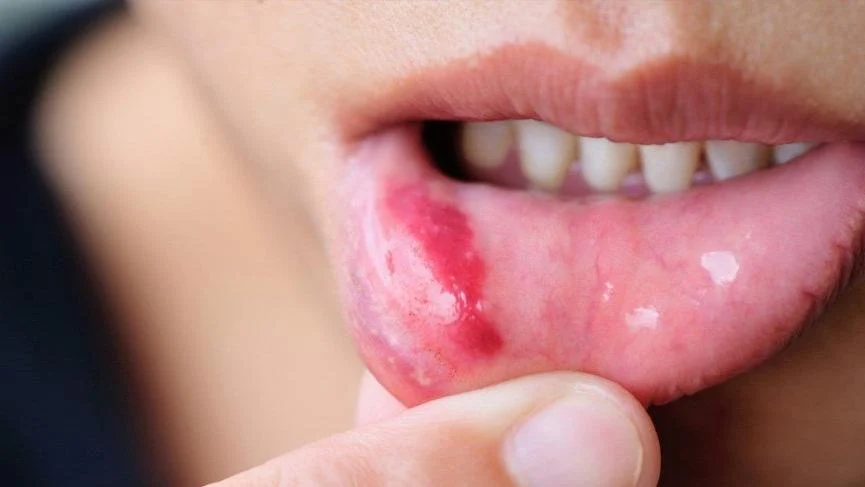Ağız ve Diş Yaralanmaları