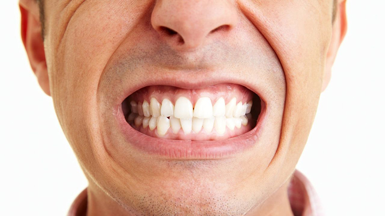 BRUKSİZM (DİŞ SIKMA VE GICIRDATMA) NEDİR VE NASIL TEDAVİ EDİLİR?