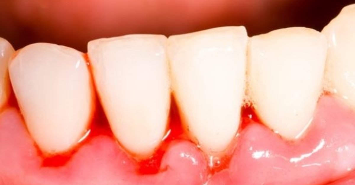 Dişetleri neden kanar?